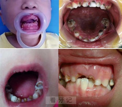 牙齿上的虫子图片