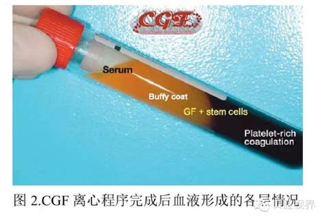口腔种植专用CGF高浓缩生长因子离心机原理及在整形美容领域的应用_中国生物器材网