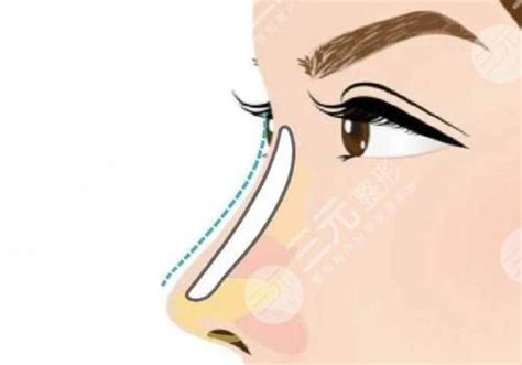 北京鼻子注射物取出+硅胶假体隆鼻手术前后对比效果图片和恢复过_珍美网