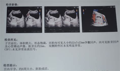 2013年2月份双胞胎B超检测单报告，帮忙看下各项属于正常不？ - 百度宝宝知道