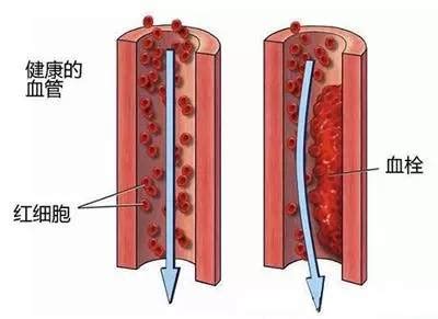 血管用多久，你就能活多久！谨记这几种行为最伤血管！