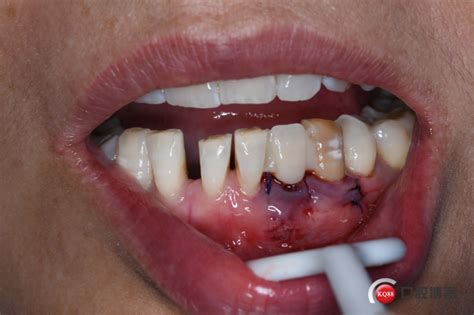 一例前牙即刻种植+根尖手术-山西牙医 王 喆的博客-KQ88口腔博客
