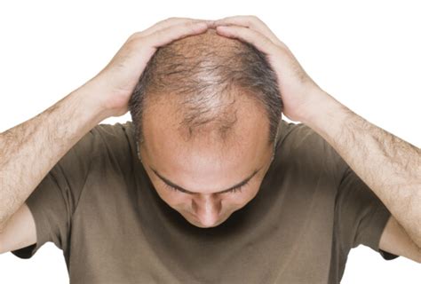明明父母不脱发，为什么你会是遗传性脱发？|脱发|遗传|遗传性_新浪新闻