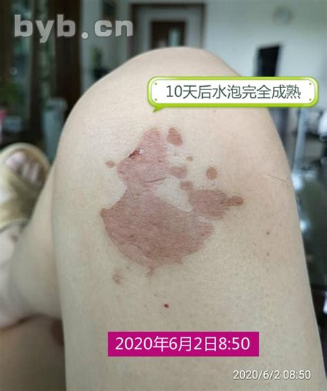 【水泡图片】【图】皮肤起水泡图片 几种皮肤水泡的处理方法(3)_伊秀健康|yxlady.com