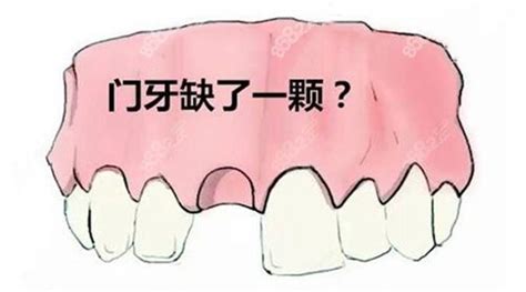 门牙缺失一颗做隐形义齿好吗?先看单颗隐形牙的优缺点再说,牙齿对比照片-8682赴韩整形网