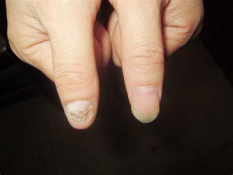 两手指灰指甲的初期症状图片_有来医生
