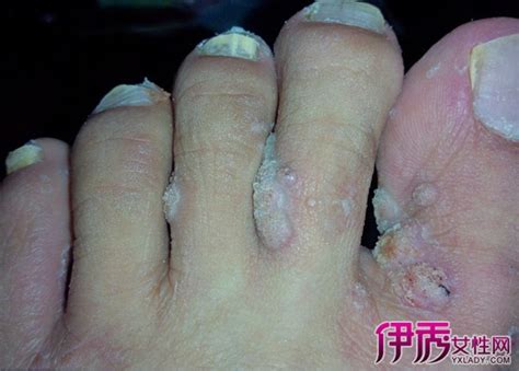 脚面发黑图片