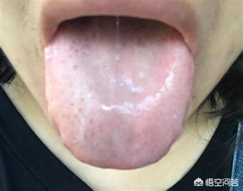 湿热舌苔图片
