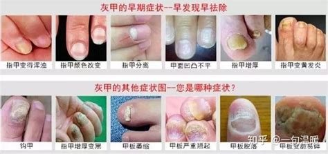 多种灰指甲的初期症状图片_有来医生