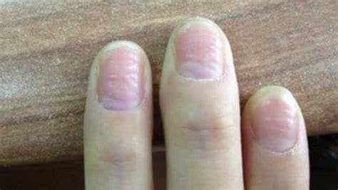 指甲上有很多竖纹是怎么回事？和肝癌有联系吗 - 知乎