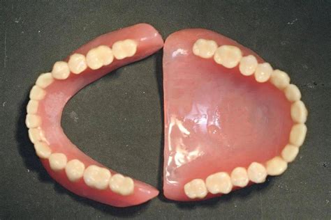 单颌全口义齿+RPD修复一例 科贸嘉友收录|义齿技术|陕西嘉友科贸有限公司