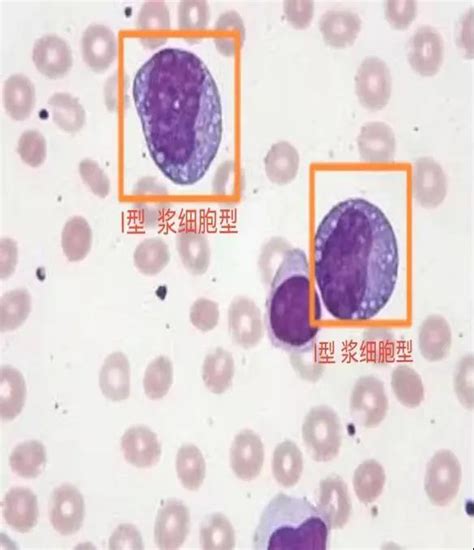 异形淋巴细胞,图,白细胞管型_大山谷图库