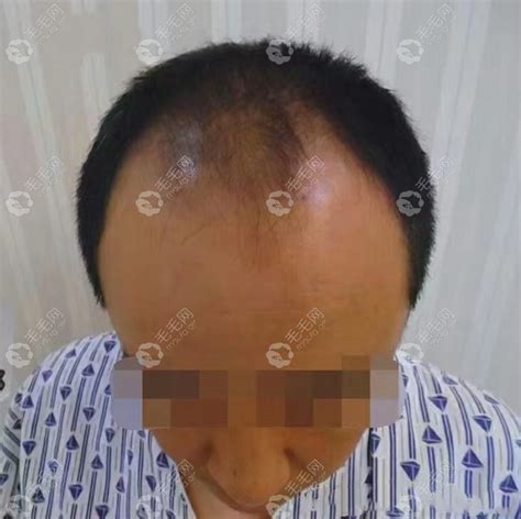 我头顶加密的植发经历让我知道了头发加密需要多少单位_四川省人民医院（医疗集团）东篱医院植发科植发案例 - 毛毛网