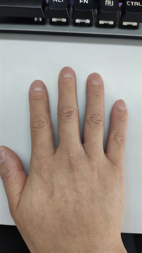 今天同事都说我这个是杵状指,说身体有严重疾病。网上查了好多，_其他科室_邻医网