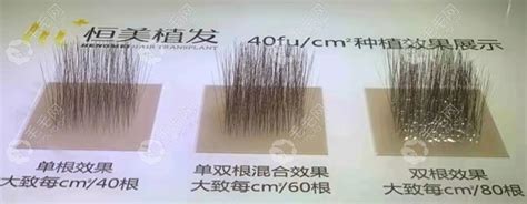 种头发一平方厘米大约可以植多少根头发?会长出50/60根头发? - 热点资讯 - 毛毛网