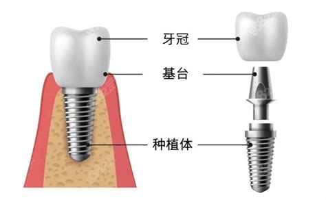 杭州西湖口腔医院价格表,种植牙/牙齿矫正/牙冠价格都有,牙齿修复-8682赴韩整形网