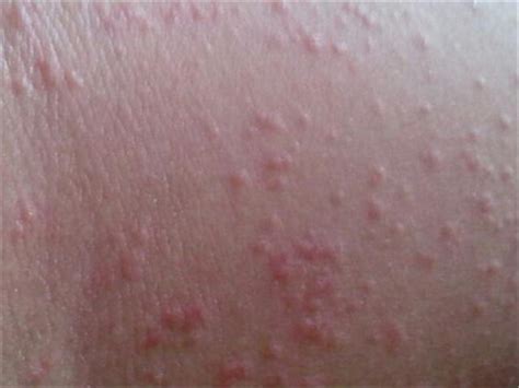 湿疹瘙痒无比，破坏肌肤，教你一个好办法，排毒去湿，湿疹好了