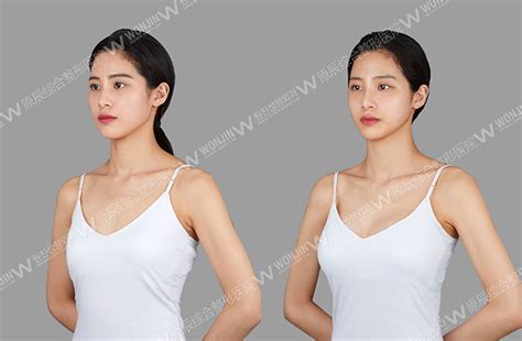 胸部案例_胸部整形对比图_隆胸手术对比照片_胸部手术对比照片_韩国原辰整形外科医院