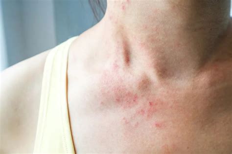 过敏导致的皮肤瘙痒，可用哪些方法缓解呢？部分过敏，会自愈吗？ - 知乎