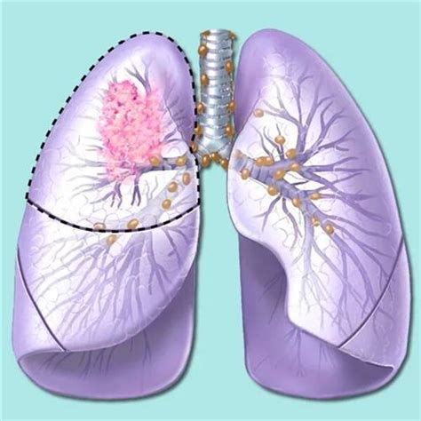 确诊晚期肺癌，你还有这些治疗方式可选-觅健
