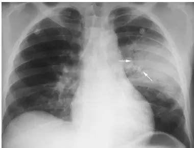 空气支气管征只在肺炎里有吗？_医学界-助力医生临床决策和职业成长