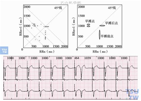 【附图】 固定频率的心室起搏节律合并室性早搏 _心电图学 | 天山医学院