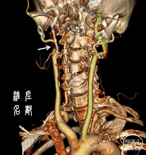 颈动脉真人图片