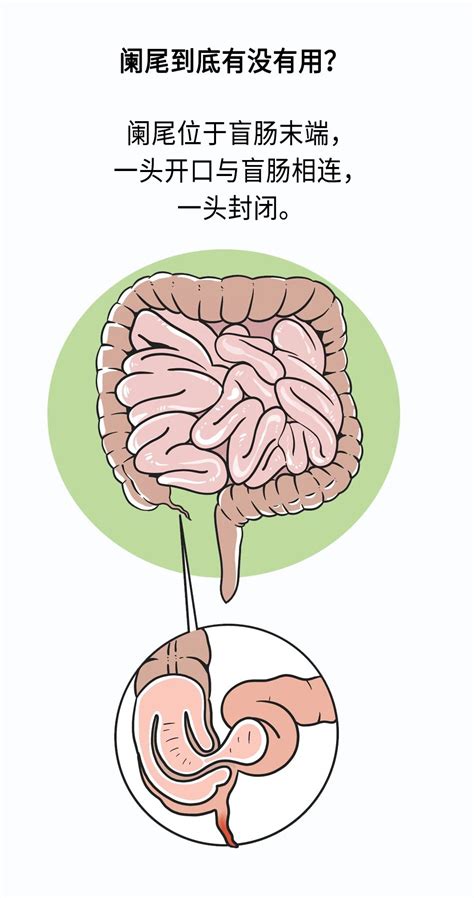 用漫画告诉你：阑尾一旦发炎是选择输液还是手术？专家有话要说！-健康教育-清华大学附属北京清华长庚医院胃肠外科