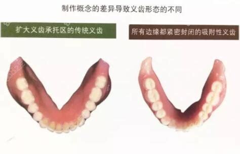 从全口吸附性义齿和普通义齿的区别,看吸附义齿到底好不好 - 口腔健康 - 毛毛网