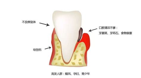 牙龈炎和牙周炎有什么区别？ - 知乎