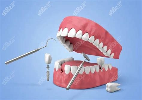 一张图让你了解“种植牙”！_牙齿_假牙_手术