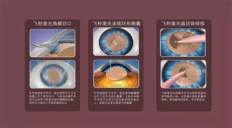 做飞秒白内障手术享受全球先进手术技术体验_武汉爱尔眼科医院