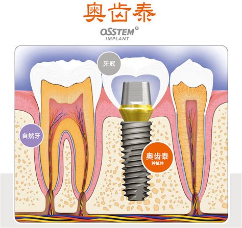 常见的种植牙系统有哪几种——广州德伦口腔