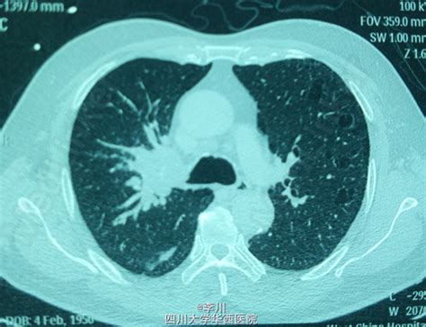 图2—90 肺鳞状细胞癌-特种医学-医学