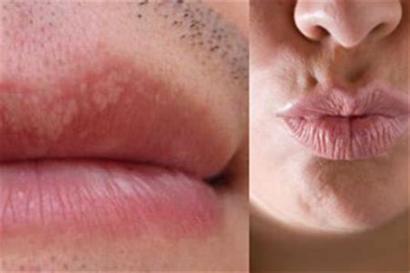 【图】为什么唇部有白色颗粒 该如何治疗_唇部有白色颗粒_伊秀美容网|yxlady.com