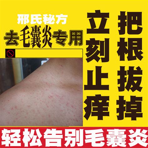 搭背疮初期图片