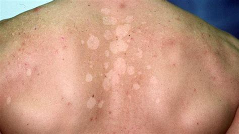 各种皮肤病图片大全 8种常见皮肤病对应的外涂药膏_华夏智能网