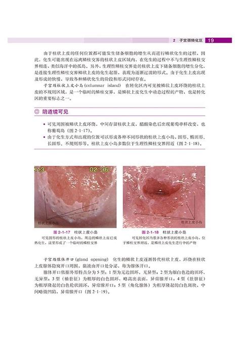 子宫颈转化区特征（2）--《子宫颈疾病——阴道镜图释》_阴道镜_妇科微创网