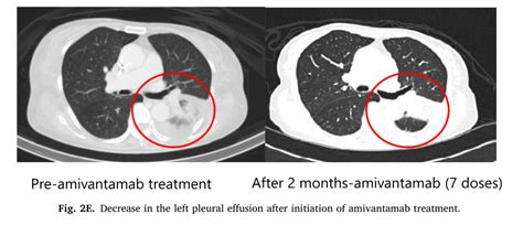 肺癌EGFR突变与靶向治疗 - 知乎