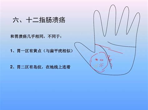 手诊图解看疾病图片