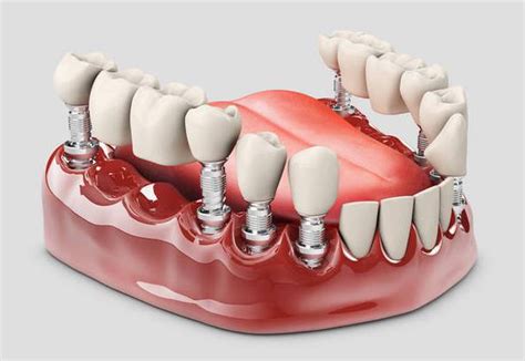 义齿制造 成都口口齿科技术有限公司