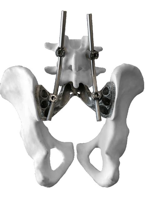 日本3D打印磷酸钙材料的人工骨，将进入美国和欧洲临床 - 3D科学谷