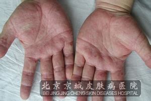 汗疱疹的发病原因是什么_汗疱疹_北京京城皮肤医院(北京医保定点机构)