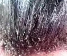 小白点头虱卵图片