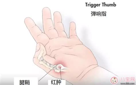 手指伸不直图片
