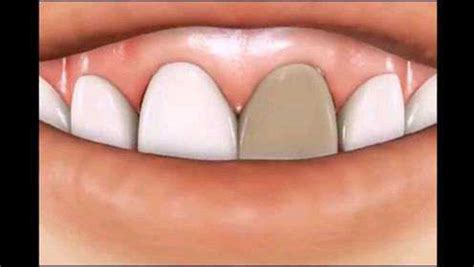 门牙根管治疗具体过程。