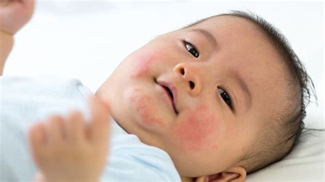 【什么是湿疹】【图】什么是湿疹 几个方法教会你治疗和预防(3)_伊秀健康|yxlady.com
