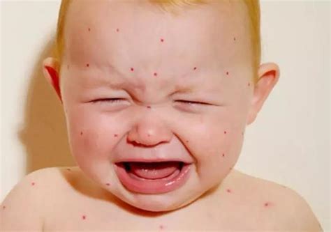 儿童常见的几种疹子类型 推荐幼儿各种疹子的症状及护理 - 遇奇吧