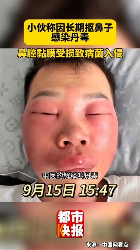 丹毒图片
