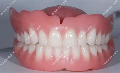 BPS吸附性义齿和普通义齿的区别,BPS义齿牢固美观/普通易脱落 - 口腔资讯 - 牙齿矫正网